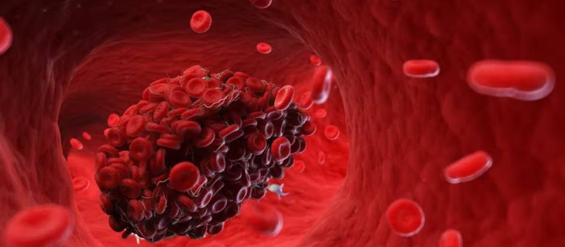 ترومبوز چیست