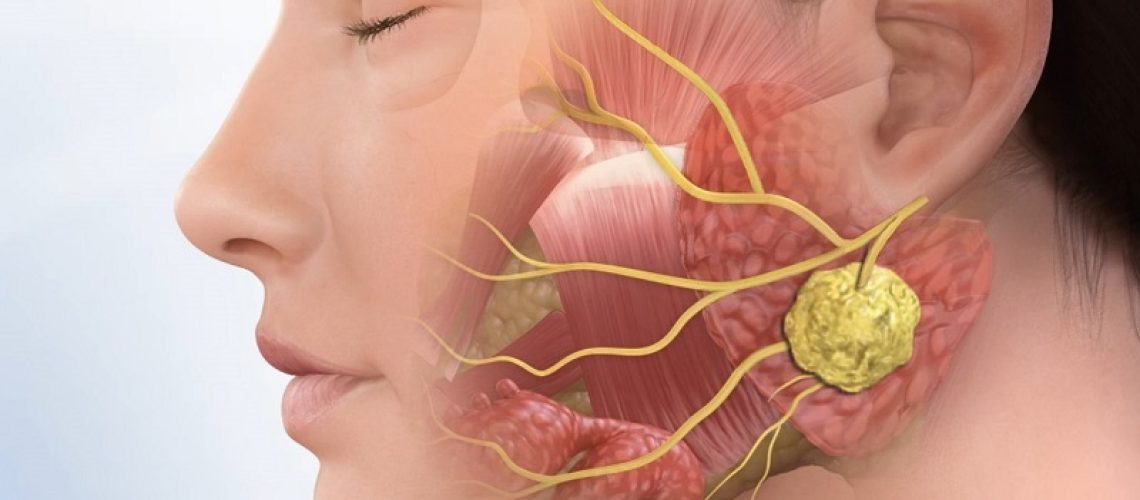 دکتر تومور غدد بزاقی