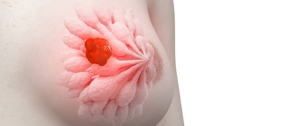 دکتر سرطان سینه